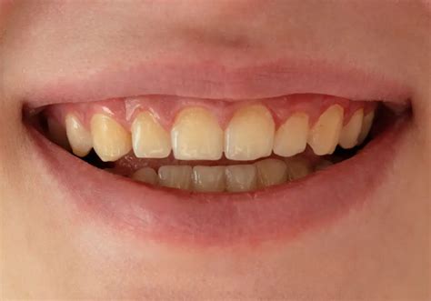 Can Yellow Teeth Become White Again Natural Home Remedies