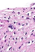 Low-grade squamous intraepithelial lesion - Libre Pathology