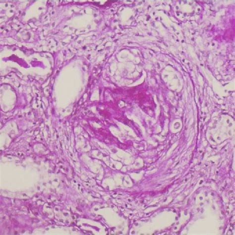 Renal Biopsy Demonstrating Mesangial Ig A Deposits Immunoflourescence