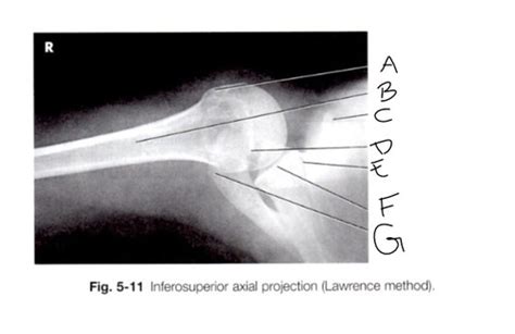 Shoulder, clavicle, scapula X-ray Flashcards | Quizlet