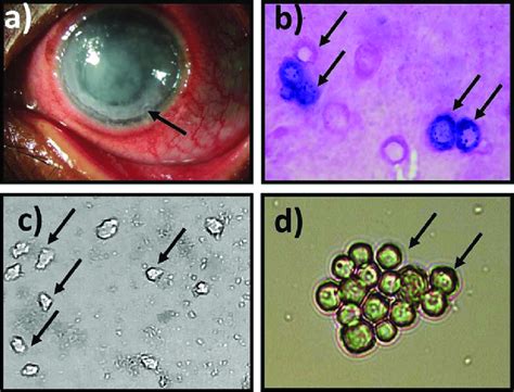 A Slit Lamp Image Of An Acanthamoeba Spp Infected Corneal Ulcer In A Download Scientific