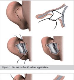 Pdf Otoplasty Outcomes And Results Does Furnas Setback Suture Affect