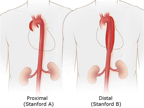 [figure Stanford Classification Of Aortic Dissection ] Statpearls