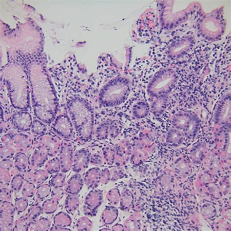 Gastric Biopsy Specimen Taken 2 Weeks After Ipilimumab Administration Download Scientific