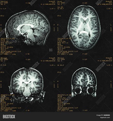 Mri Child's Brain Image & Photo (Free Trial) | Bigstock