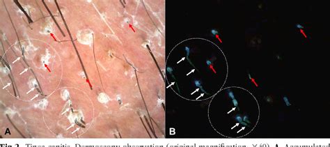 Figure 2 From Ultraviolet Dermoscopy For The Diagnosis Of Tinea Capitis Semantic Scholar