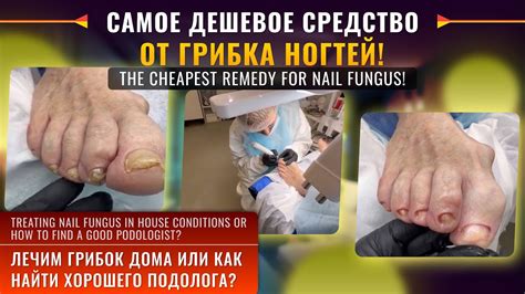 Самое дешевое средство от ГРИБКА НОГТЕЙ! Лечим грибок дома или как ...