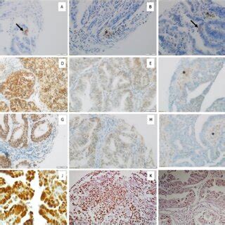 Examples Of Different Immunohistochemical Expression Patterns PD L1