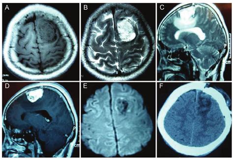 Neuroimaging For An Angiomatous Meningioma At Left Frontal Region A A