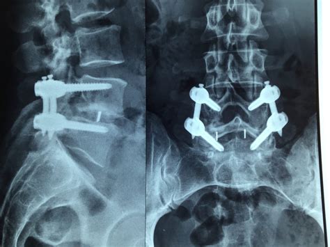 Artrodese Da Coluna Lombar Minimamente Invasiva Mip Iot Coluna