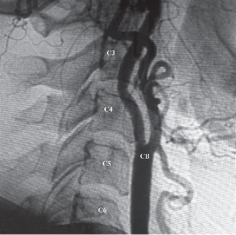 Figure 1 From Morphological Variation Of Carotid Artery Bifurcation