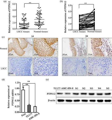 Ptpn Down Regulated By Mir B P Gene Affects The Malignant