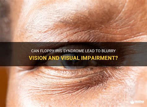 Can Floppy Iris Syndrome Lead To Blurry Vision And Visual Impairment