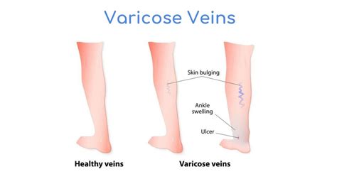 Ppt Varicose Vein Treatment Powerpoint Presentation Free Download