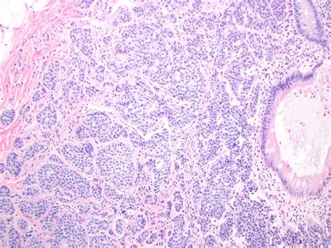 Langerhans Cell Histiocytosis Blog