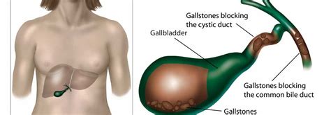 Gallbladder Stones Operation