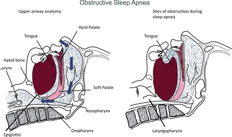 Advan Physiology Org Osas Upper Airway Obstruction Bedroom Solutions