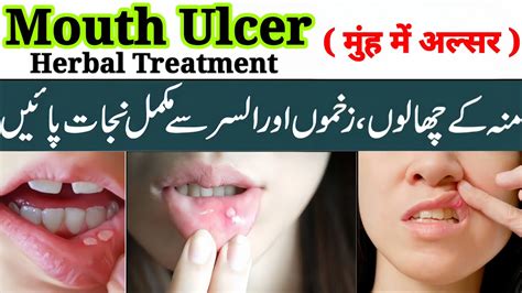 Moo K Chalon Ka Ilaj Hakeem Muhammad Shaban Khan Mouth Ulcer