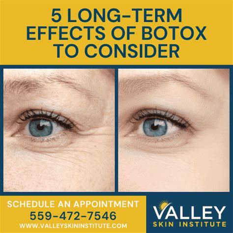 5 Long Term Effects of Botox to Consider | Botox Treatment