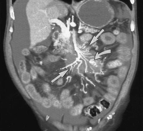 Multi Detector Row Ct Of Mesenteric Ischemia Can It Be Done Radiographics