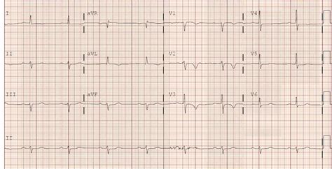 Ekg Of The Day Yo F Known Htn Cad Hx Angioplasty Currently On