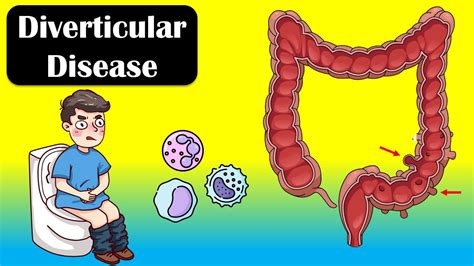 Diverticular Disease And Diverticulitis Causes Signs And Symptoms