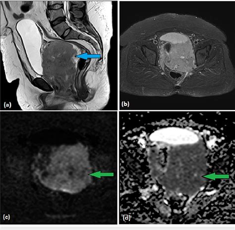 Mri T W Sagittal A Axial Stir B Dwi C And Adc D Images