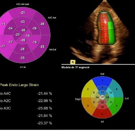 N Ammonia Pet Ct Mpi Apical Inferior And Inferoseptal Severe