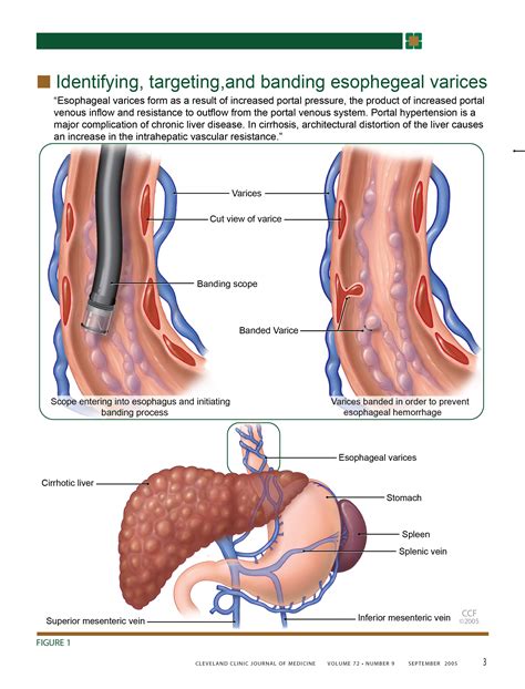 Esophageal Varices: Symptoms, Causes Treatment, 54% OFF