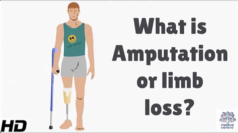 What Is Amputation Or Limb Loss Youtube