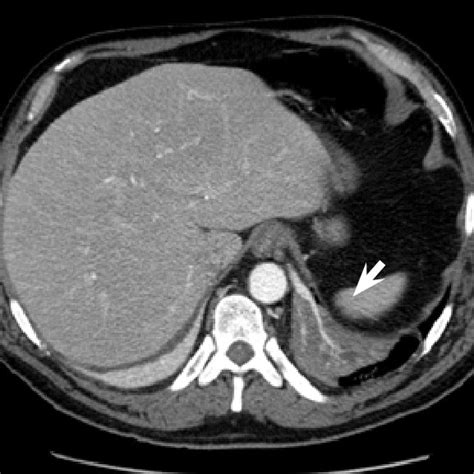 Contrast computed tomography scan. Pulmonary sequestration at the base ...