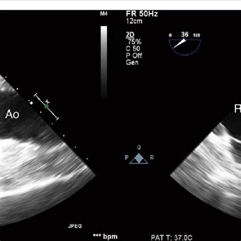 Mid Esophageal Mitral Commissural View Left And Long Axis View