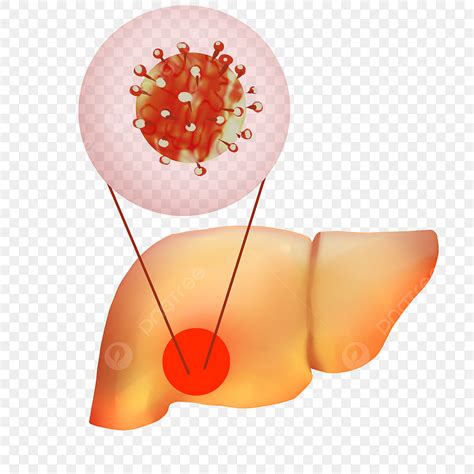 Infección Por El Virus De La Hepatitis Hepática PNG dibujos Cuerpo