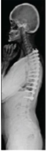 Ag Clavicular Hypoplasia Widened Pubic Symphysis Bilateral Coxa