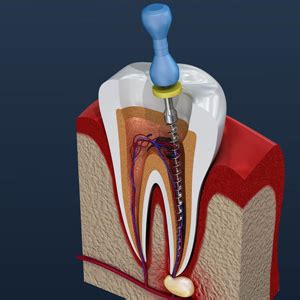 Root Canal Treatment My Dentist