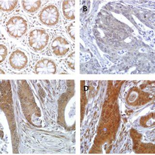 Representative Gs Immunohistochemical Staining In Crc With A