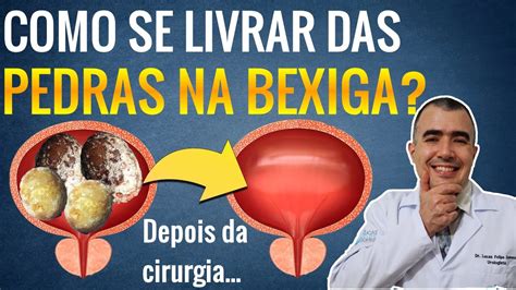 Qual A Melhor Cirurgia Para Tirar Uma PEDRA NA BEXIGA YouTube