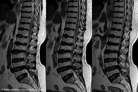 Scheuermann's disease - meddic