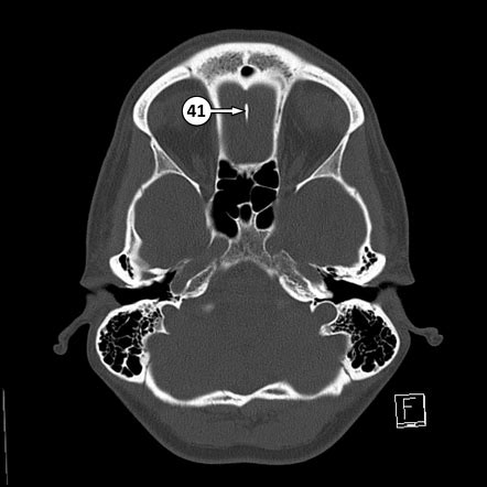 Crista Galli Anatomy