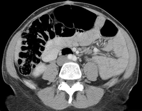 Ct Findings In Adult Celiac Disease Radiographics