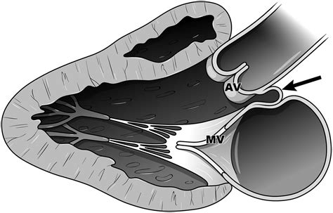 CT And MRI Features Of Pseudoaneurysms Of The Mitral Aortic