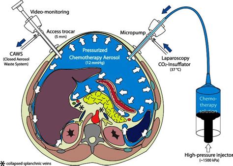 Pipac Para Carcinomatosis Peritoneal En Barcelona Qu Net Torrent