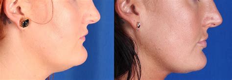 Coolsculpting Chin Before After 5 Coolsculpting