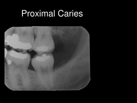 Ppt Radiographic Interpretation Of Dental Caries Powerpoint