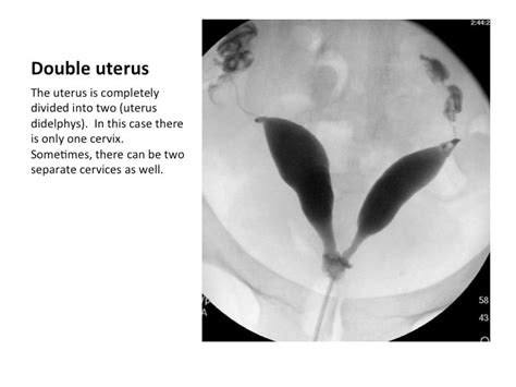 Commonly Seen Uterine Abnormalities On Hysterosalpingography Hsg