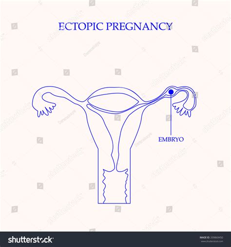 Ectopic Pregnancy Concept Vector Illustration Shutterstock