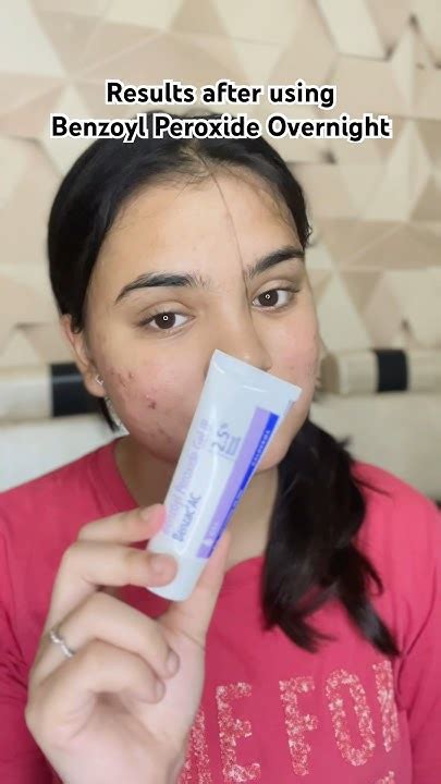 Results After Using Benzoyl Peroxide Overnight😊 Youtube