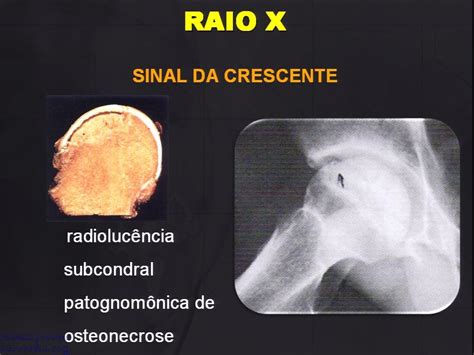 Radiologia Do Quadril E Pelve Traumatologia E Ortopedia