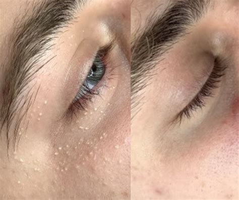 Milia Removal Before And After