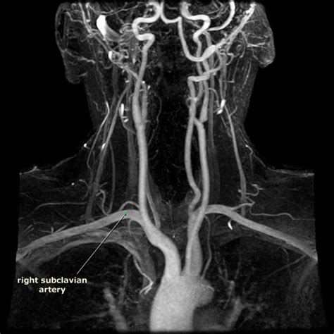 Index of /Neuro/Radiology/rad_vasculature/MRA_neck